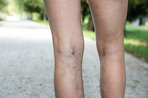 Varicose veins can cause leg pain