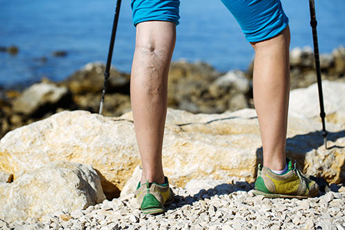 Vericose veins may be an indicator venous thrombosis